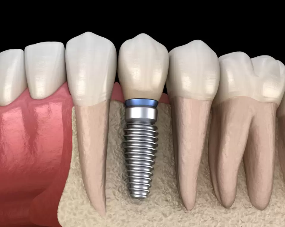 3D rendering of a dental implant